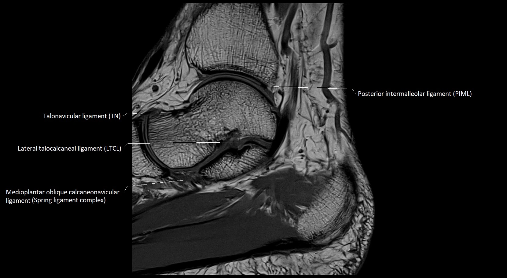 MRI ankle ligaments anatomy sagittal 3T image 10.webp